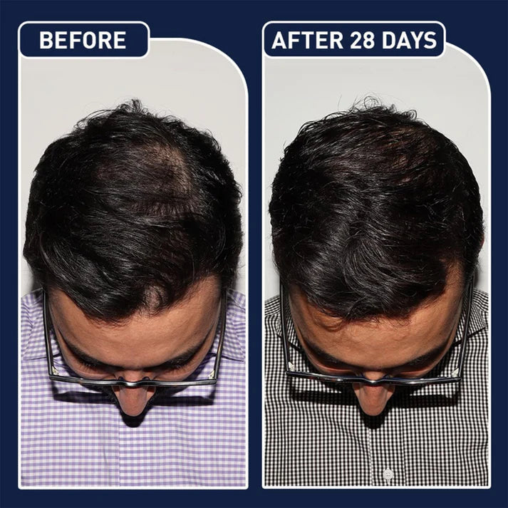FEG Hair Growth Spray Plus Derma Roller Pack of 2 Suitable For Both Men and Women