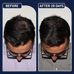 FEG Hair Growth Spray Plus Derma Roller Pack of 2 Suitable For Both Men and Women
